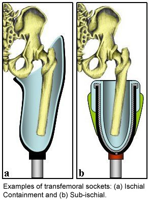 subischial_leg.jpg